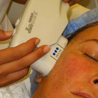 Ultherapy is an innovation in non-invasive tissue lifting