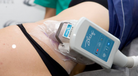 Zeltiq requires no recovery time and is practically painless